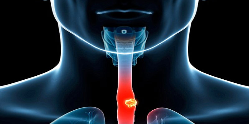 Active or passive smoking leads to cancer in 'voice box'